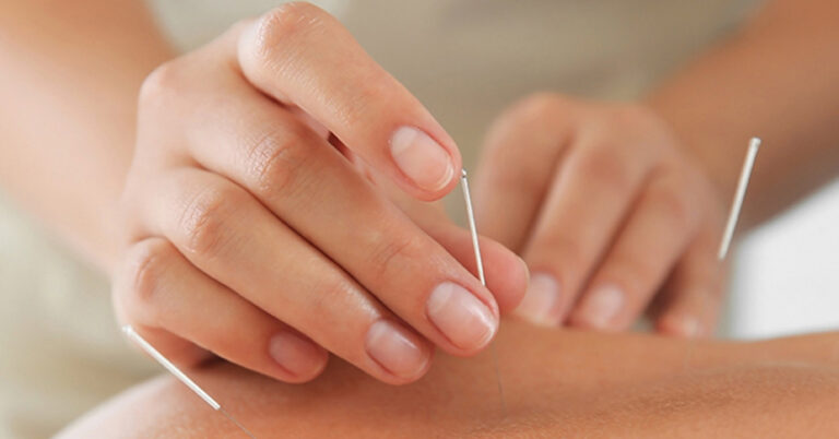 Acupuncture: qu’est-ce que c’est? 
